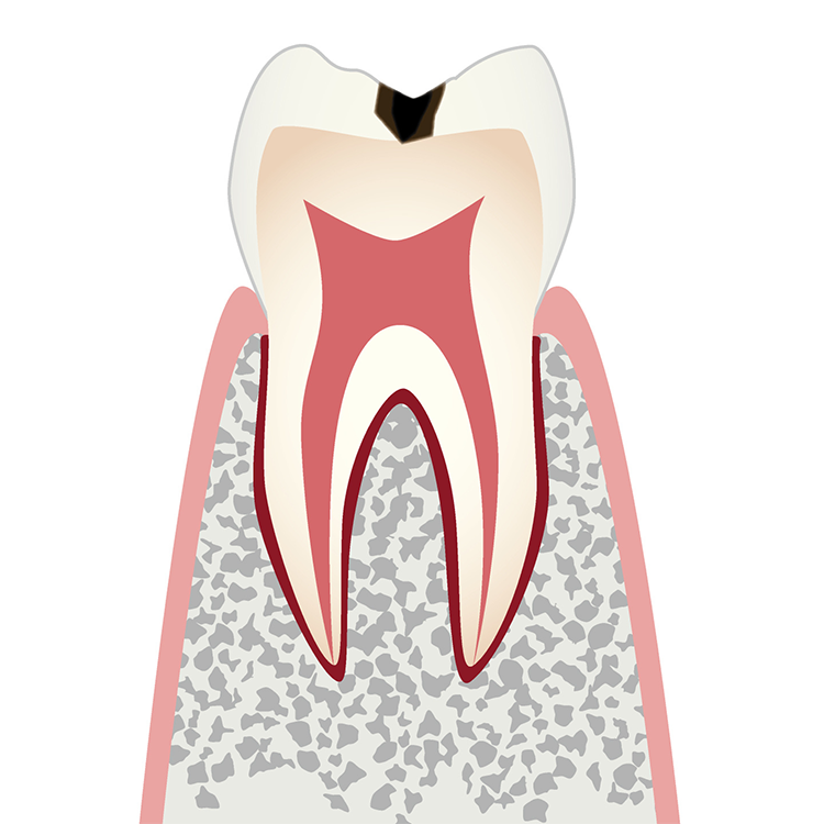 C1 エナメル質の虫歯