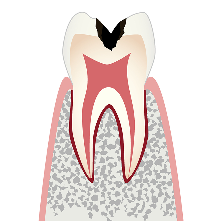 C2 象牙質の虫歯