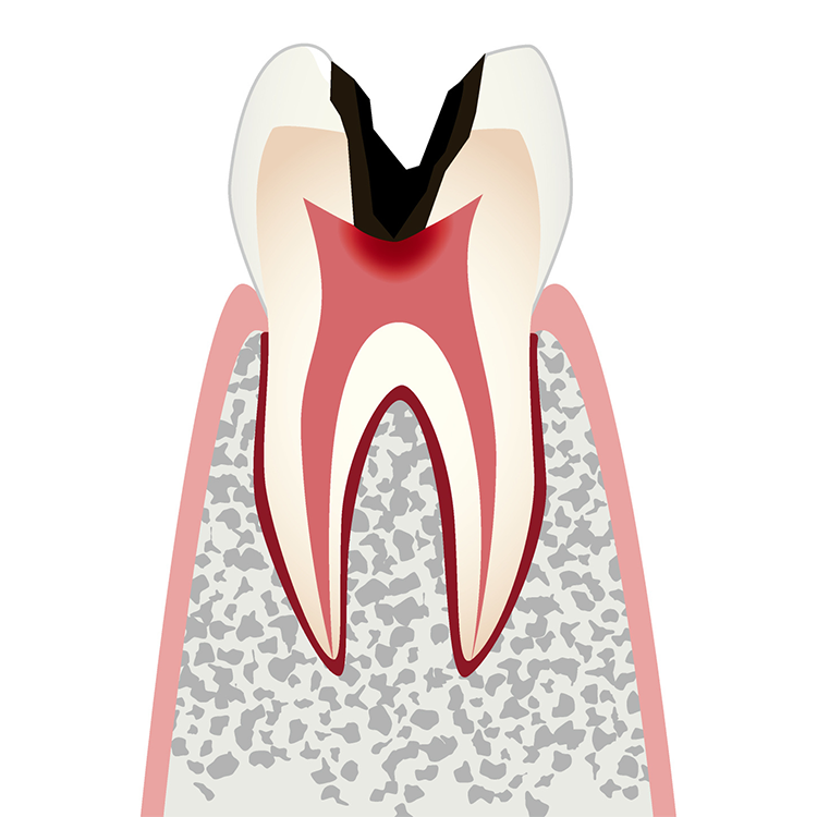 C3 歯髄の虫歯