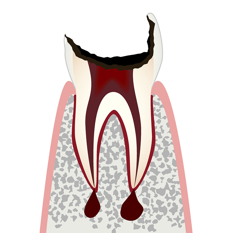 C4 歯髄が壊死した虫歯