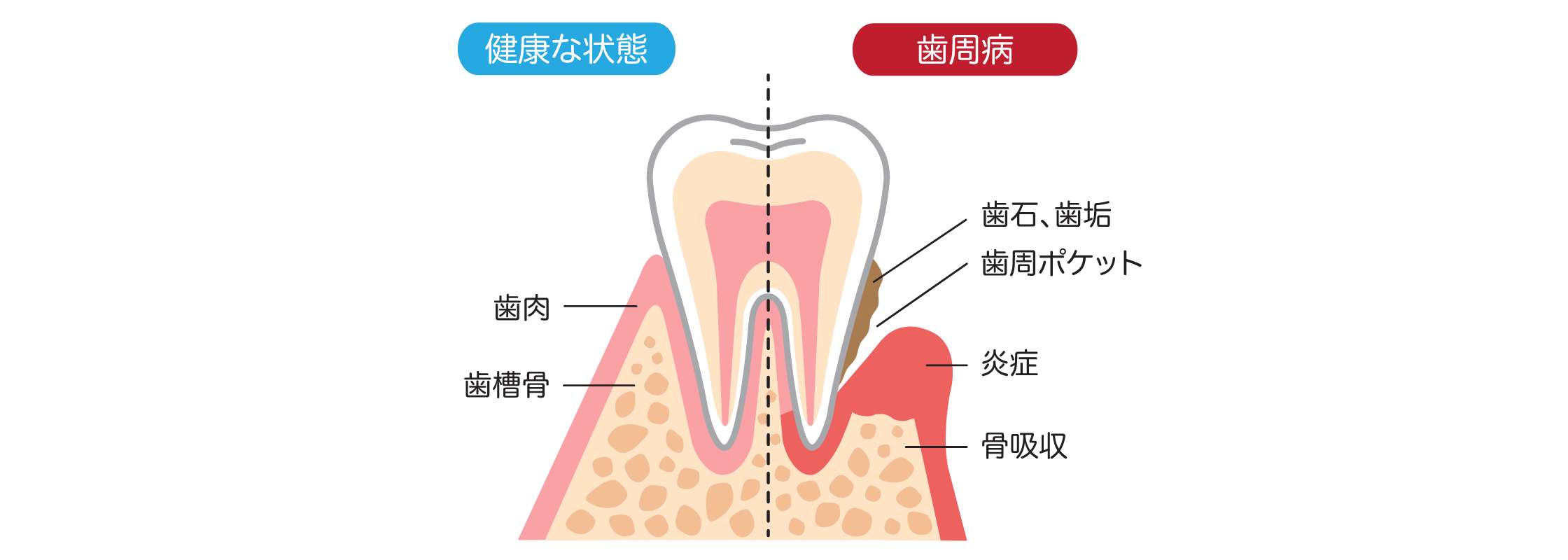 歯周病