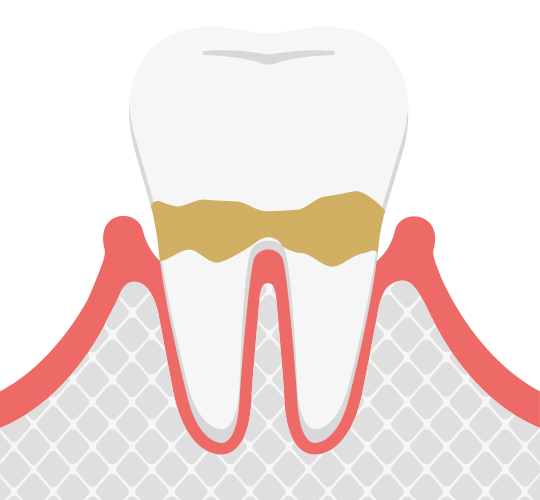 軽度歯周炎